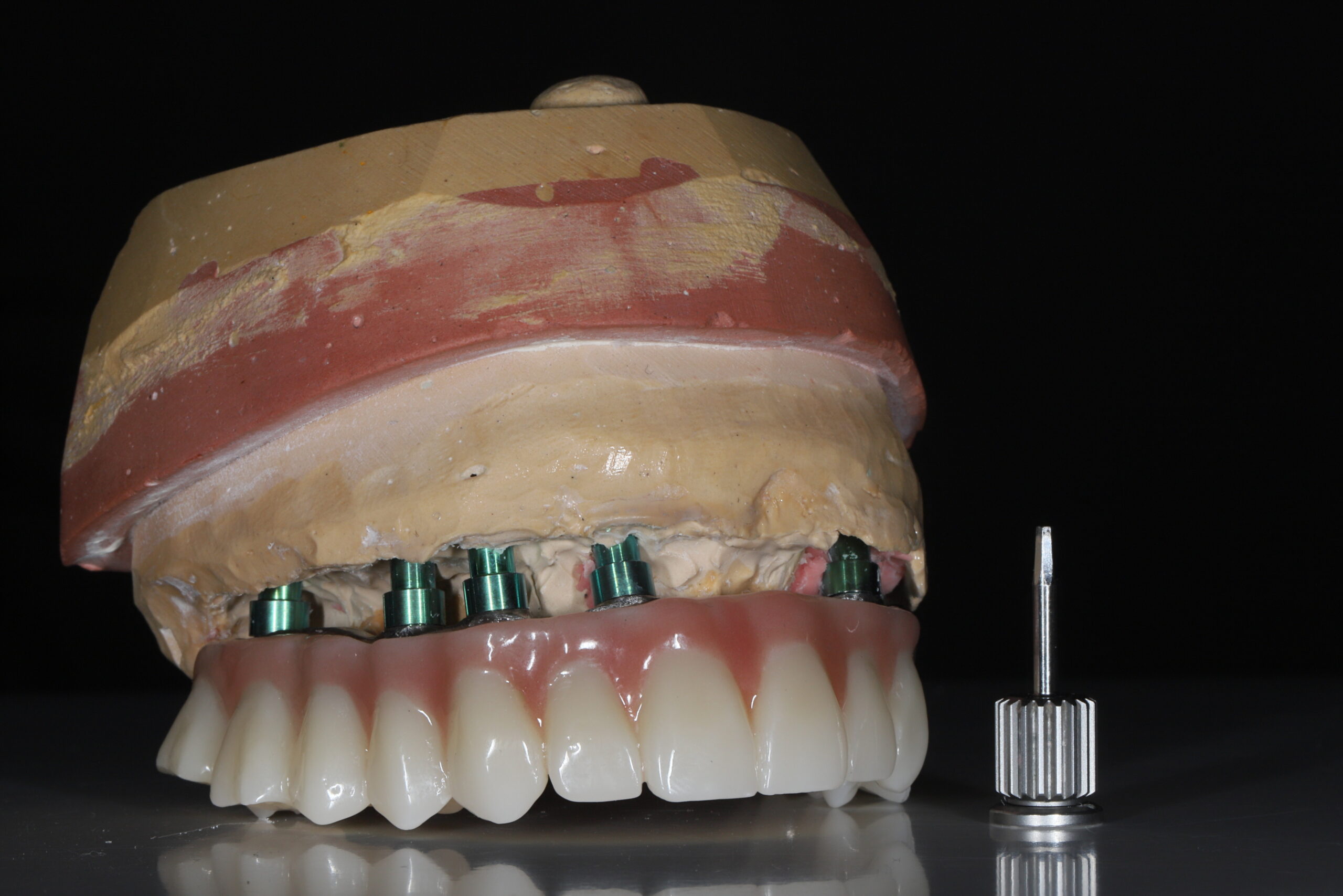 Full-arch porcelain implant-supported dental prosthesis for edentulous jaws with All-on-X and All-on-4 treatment procedure using dental implant surgery.