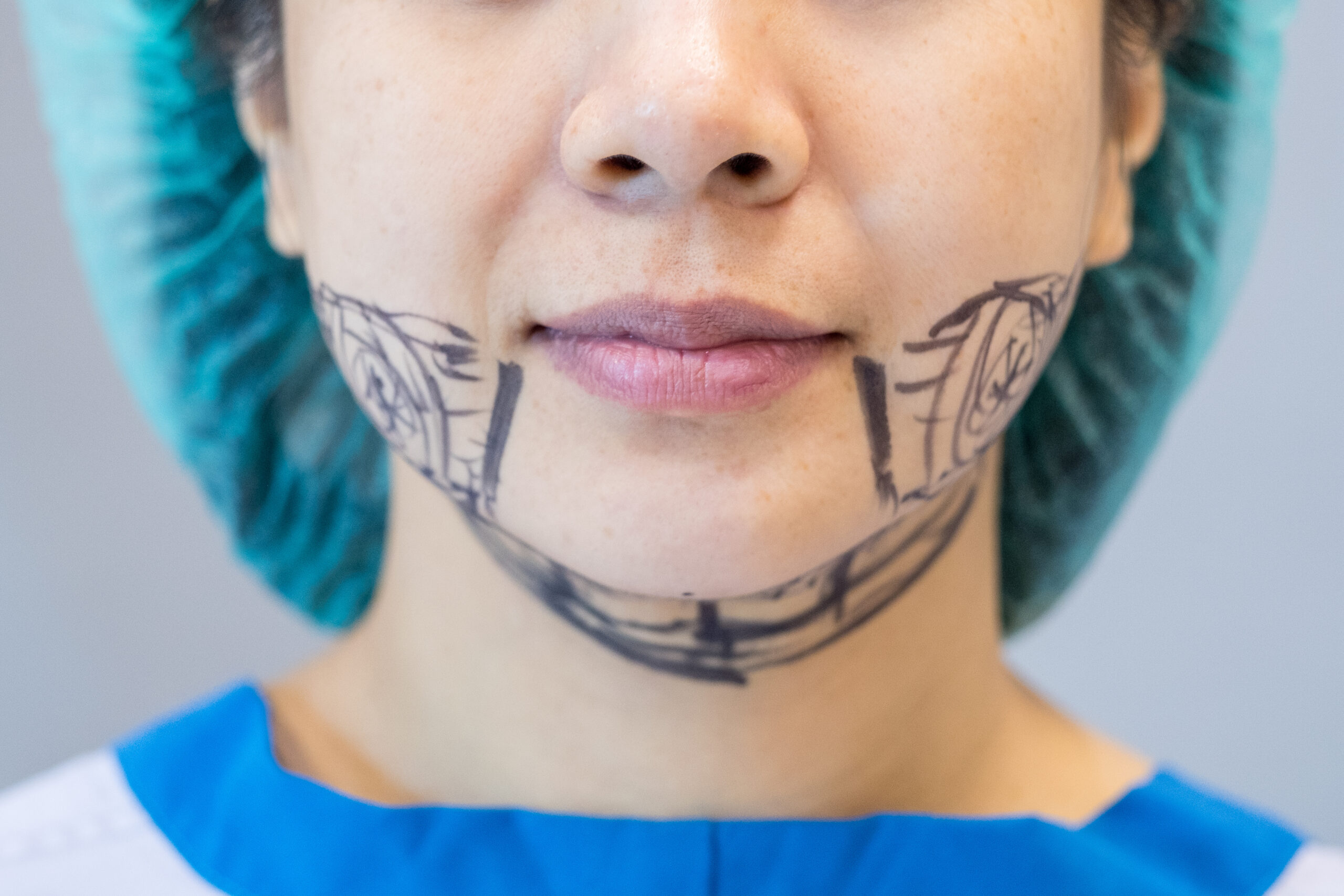 surgery, jaw surgery