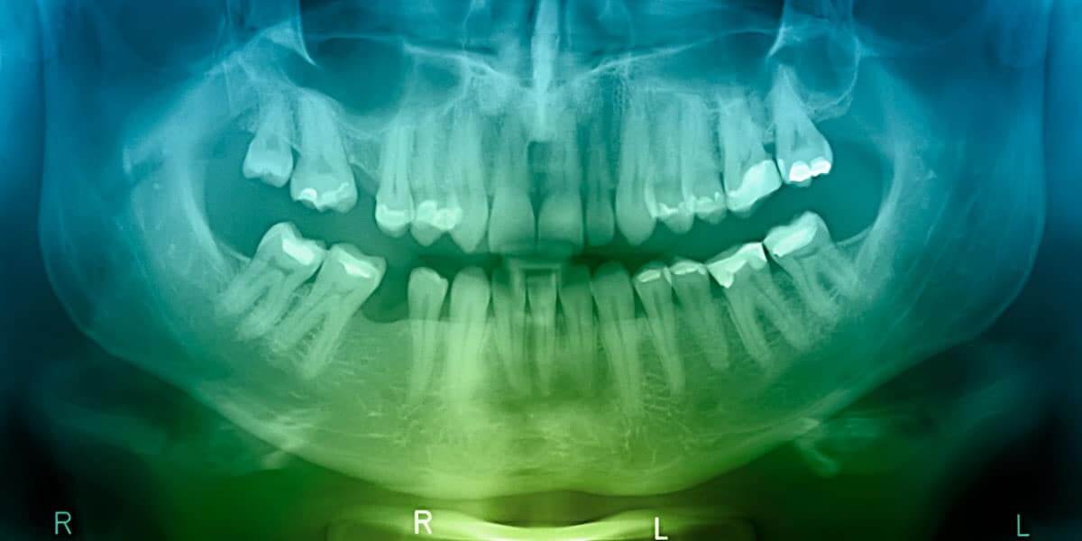 Bone Grafting